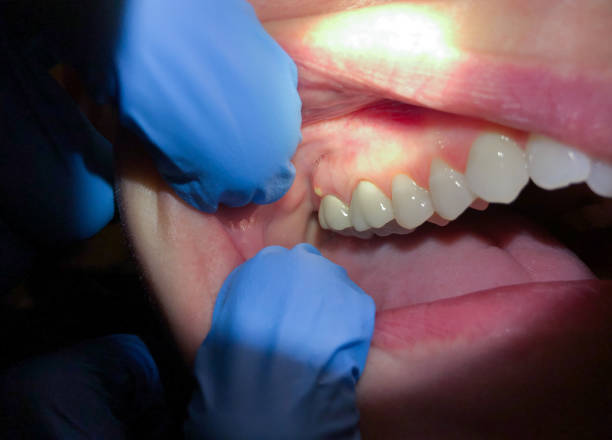 Best Emergency Dental Extractions in Richland, PA